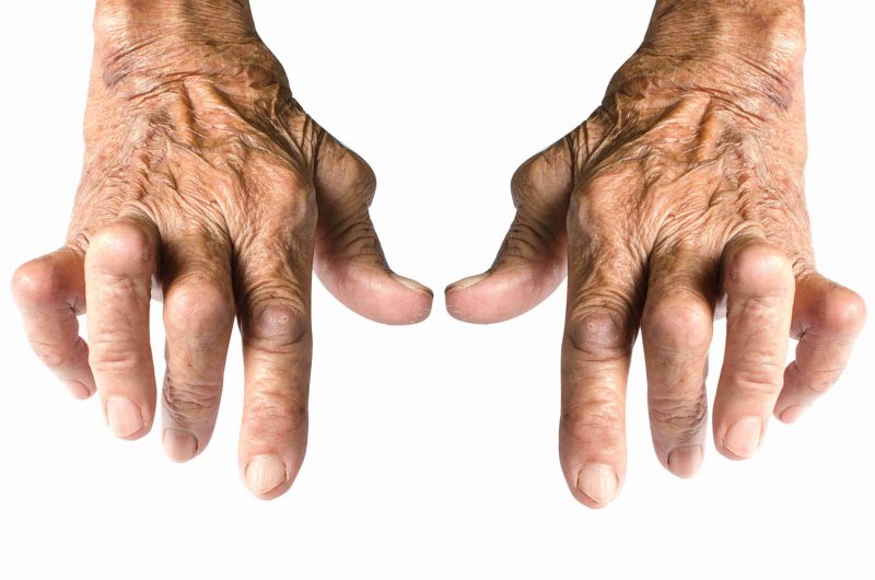 elder with arthritis in hands