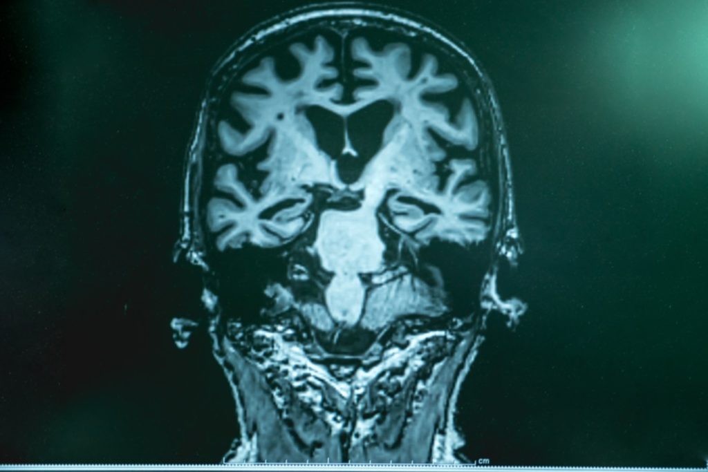 Brain scan of an Alzheimer’s patient