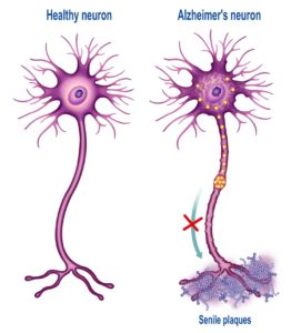 A healthy neuron vs. a neuron of an Alzheimer’s patient