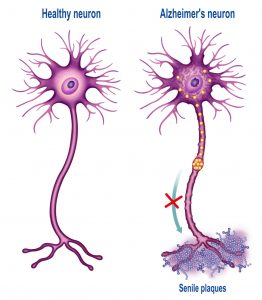 healthy neuron vs with alzheimer's neuron
