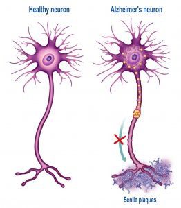 Image representation of Pathophysiology of Alzheimer’s Disease