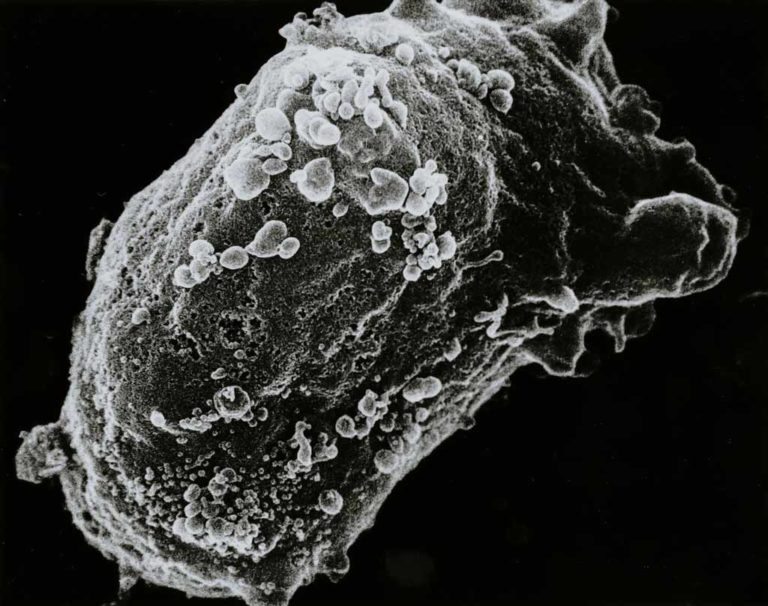 A lymphocyte with an HIV cluster