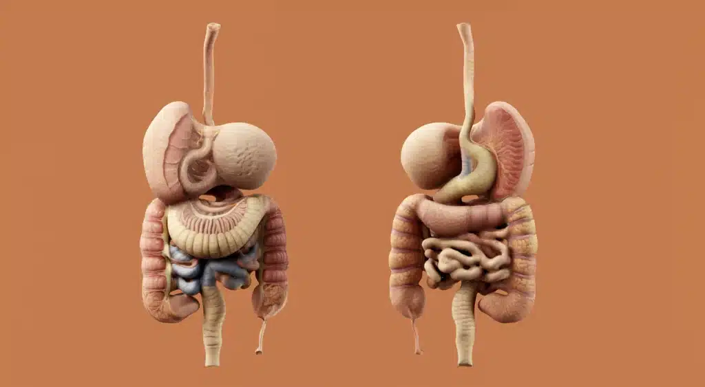 Is Crohn’s Disease Fatal? Anatomical illustration comparing healthy and inflamed digestive systems affected by Crohn’s disease.