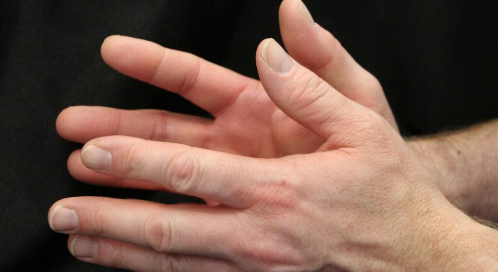 Hands showing joint stiffness and inflammation commonly associated with rheumatoid arthritis, related to the question: Is Rheumatoid Arthritis Hereditary?